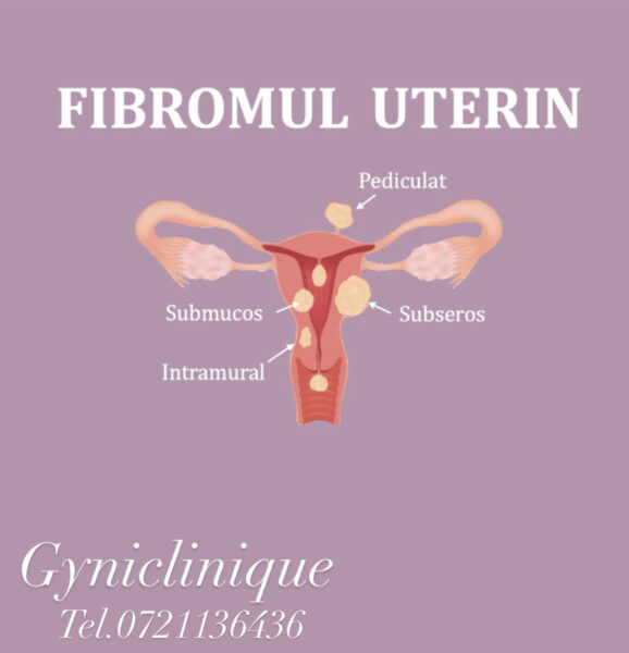 Ce este fibromul uterin si cand trebuie operat?